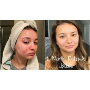 Cele mai Bune Geluri Tretinoin-Rezultate si Beneficii Asupra Pielii