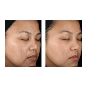 tretinoin